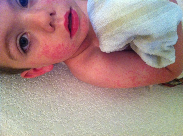Fifth Disease Virus Hits Our Home - Foster2Forever